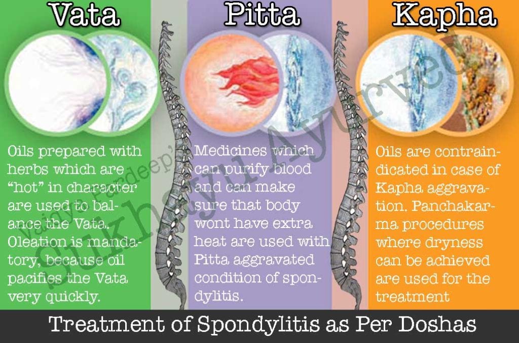 Ayurvedic treatment for spondylitis.