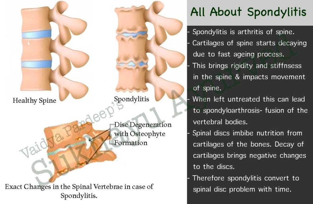 All about Spondylitis