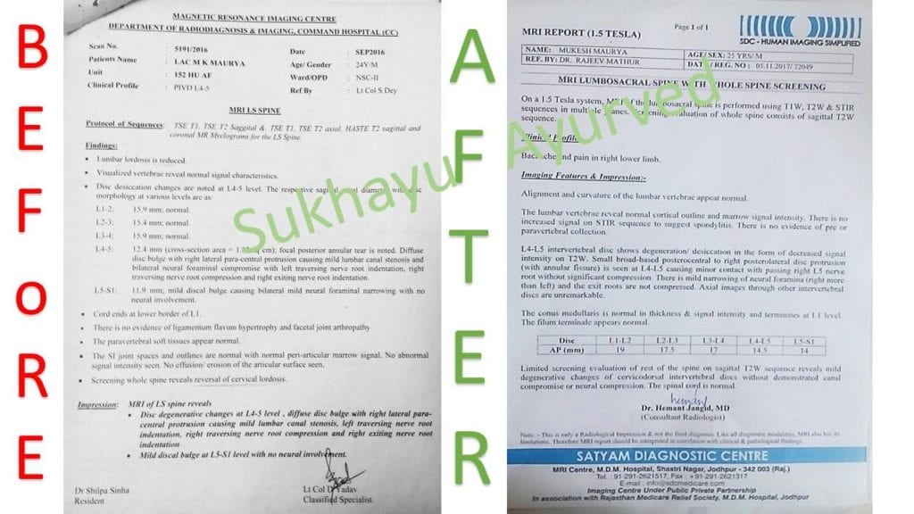 Ayurvedic Treatment for Canal Stenosis