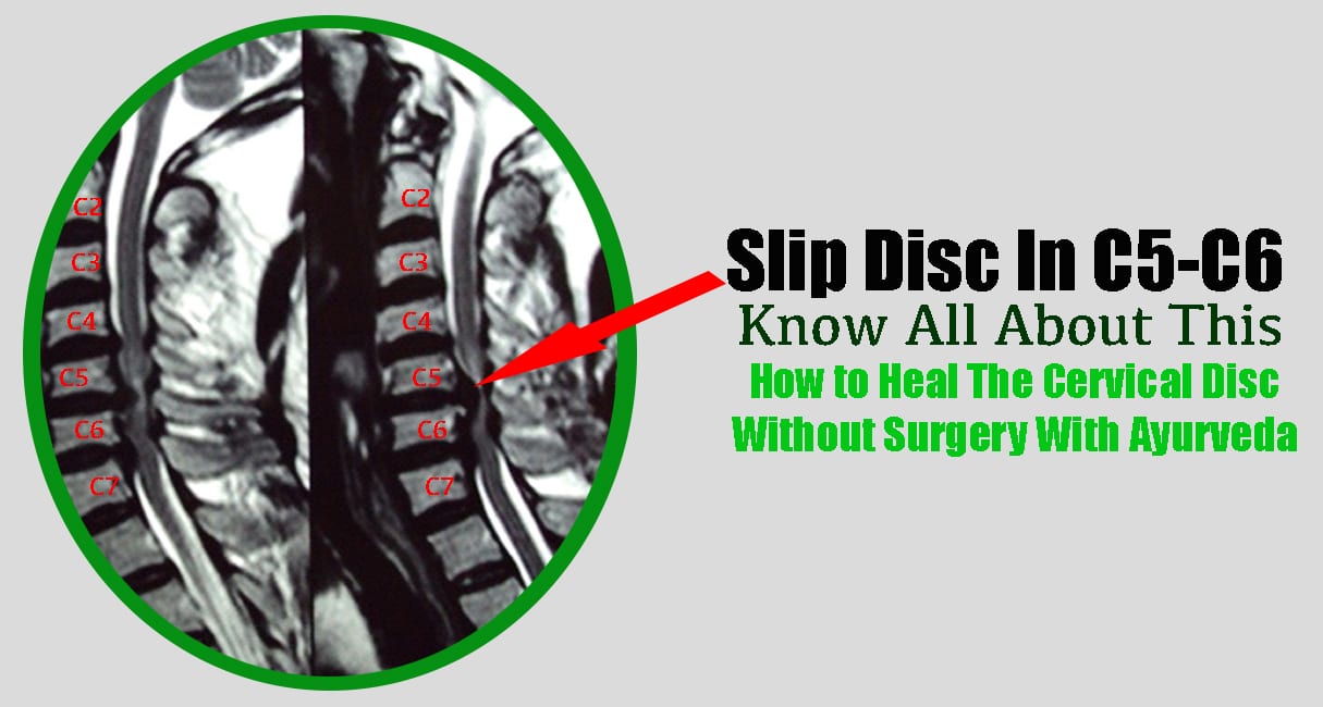 Ayurvedic treatment for C5C6 slip disc without surgery