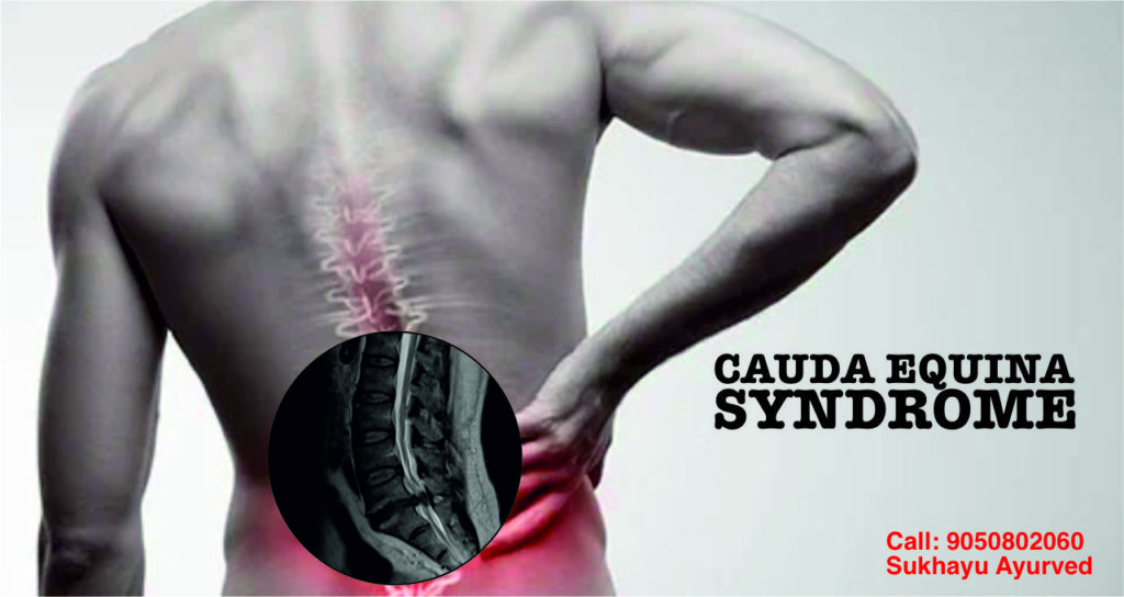 cauda equina syndrome ayurvedic treatment